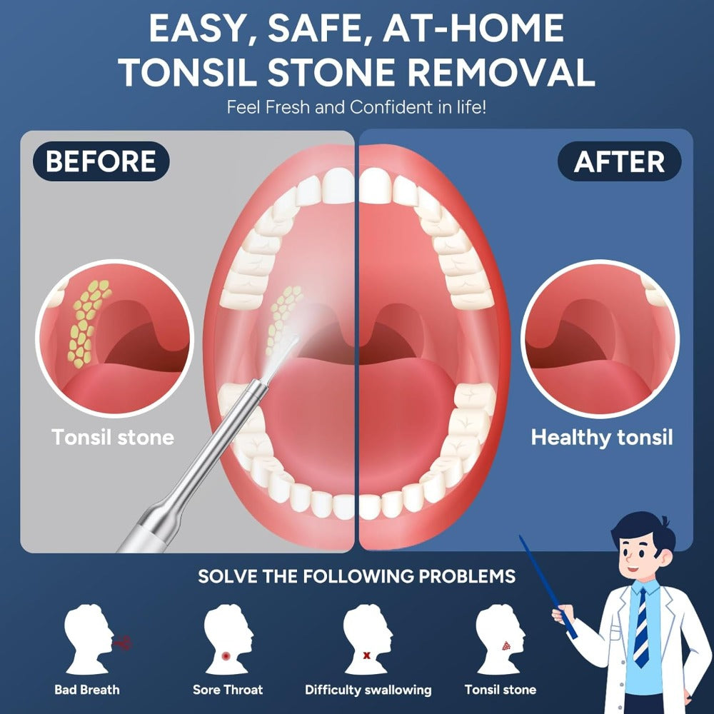 Visual Tonsil Stone Remover with 1080P HD Camera ¨C 6 LED Lights, 5 Stainless Steel Heads, Bad Breath Prevention, iOS & Android Compatible, At-Home Tonsil Care Kit