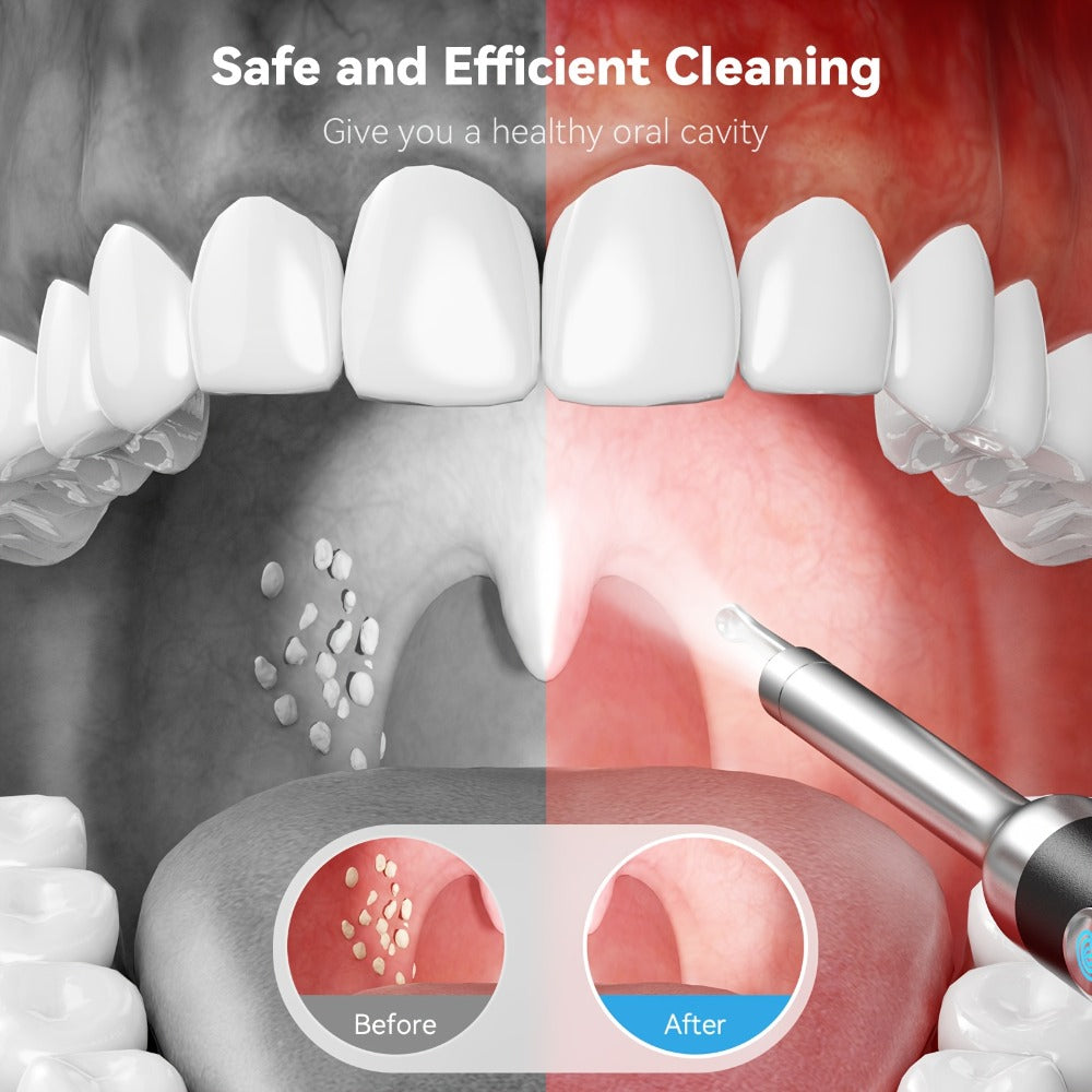 Intelligent Visual Tonsil Stone Removal Kit ¨C 1080P HD Camera, 6 LED Lights, Wi-Fi & App Connection, Multi-Accessory Oral Inspection Tool for All Ages